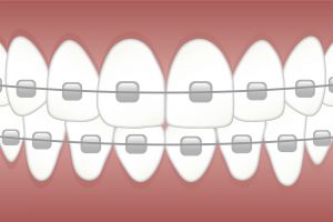 Verzekeringen orthodontist
